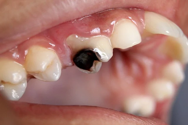 tooth cavity